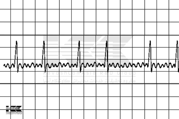 ضربان قلب منظم