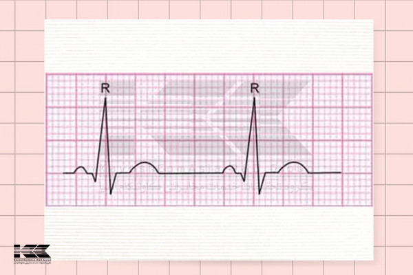 تفسیر نوار قلب ECG: تعیین نظم  قلب