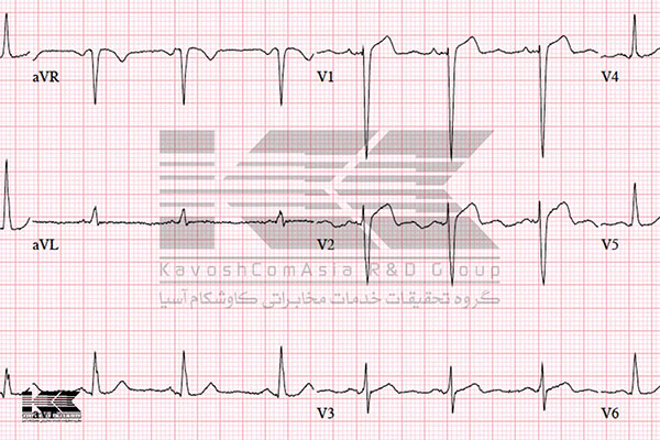 عوامل موثر در قیمت دستگاه نوار قلب ECG